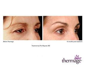 热玛吉眼部操作流程视频,热玛吉眼部操作流程详解