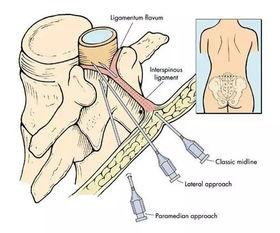 椎管内麻醉视频