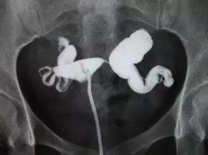 输卵管积水手术视频过程,输卵管积水手术全过程解析